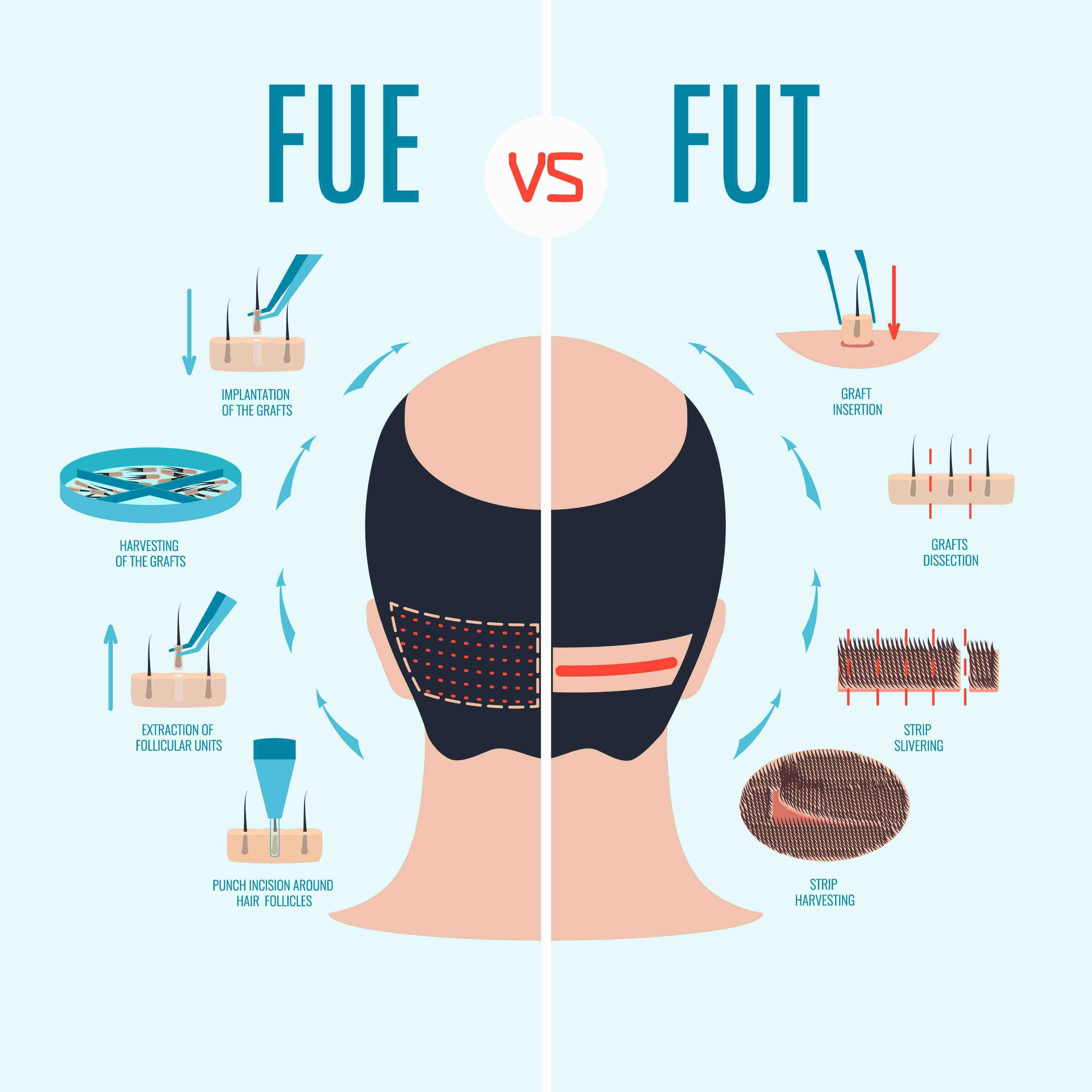 FUE vs FUT Hair Transplant Methods