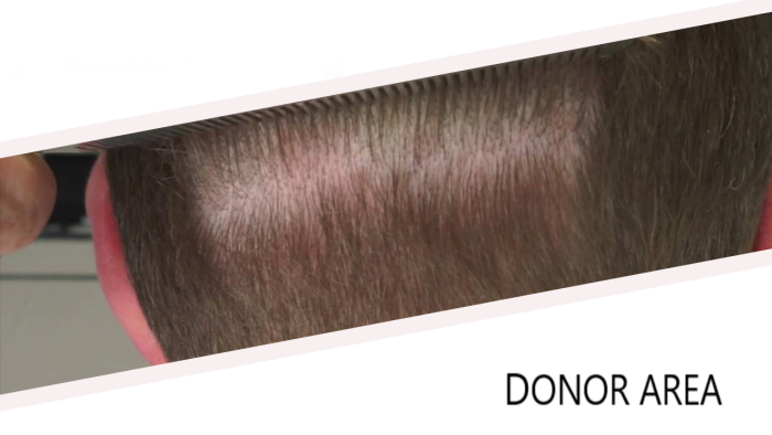Hair transplant donor area