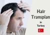 hair transplant prices in Turkey