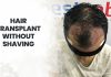 hair transplant without shaving