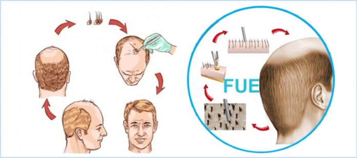 Follicular hair extraction